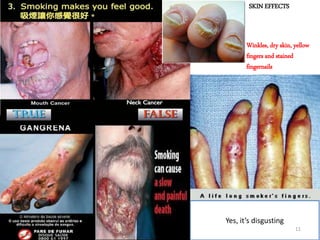 SKIN EFFECTS
Winkles, dry skin, yellow
fingers and stained
fingernails
Yes, it’s disgusting
11
 