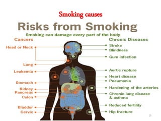 Smoking causes
13
 