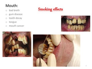Smoking effects
Mouth:
o bad breth
o gum disease
o tooth decay
o tongue
o mouth cancer
7
 