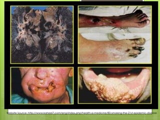 Website Source: http://www.kaheel7.com/eng/index.php/health-a-medicine/80-smoking-the-21st-epidemic-disease
 