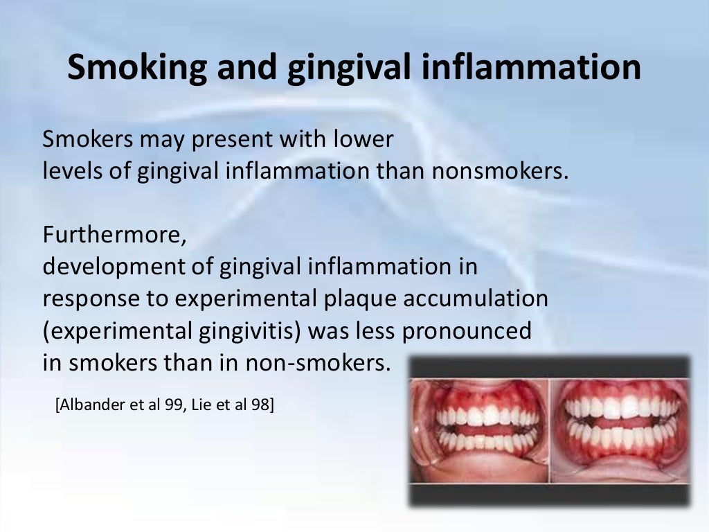 Smoking & periodontium