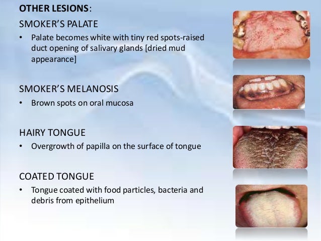 Smoking Periodontium - 