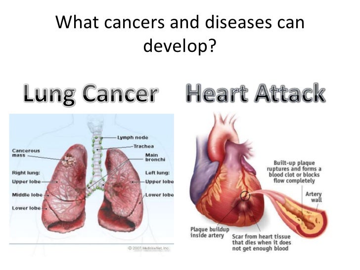 type of cancer caused by smoking a pipe