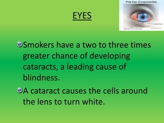 EYES
Smokers have a two to three times
greater chance of developing
cataracts, a leading cause of
blindness.
A cataract causes the cells around
the lens to turn white.
 
