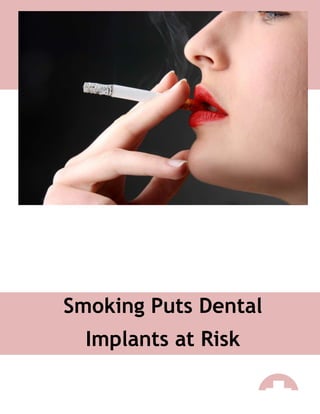 Smoking Puts Dental
Implants at Risk
 