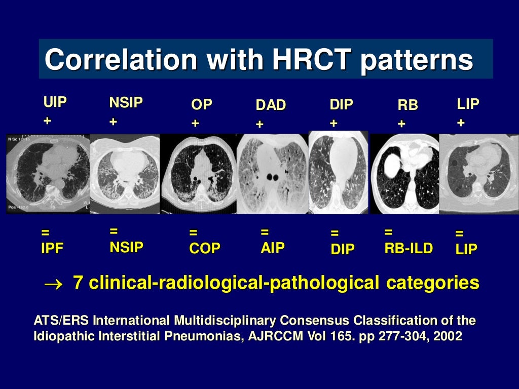Smoking Related Interstitial Lung Diseases