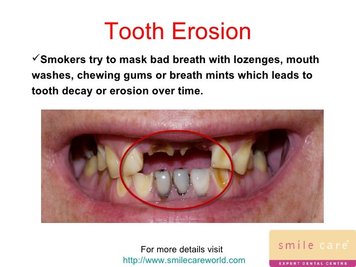 Smoking & Your Teeth