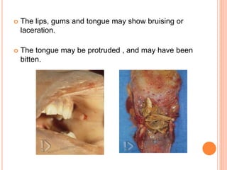  The lips, gums and tongue may show bruising or
laceration.
 The tongue may be protruded , and may have been
bitten.
 