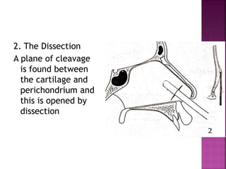 2. The Dissection
A plane of cleavage
is found between
the cartilage and
perichondrium and
this is opened by
dissection
 