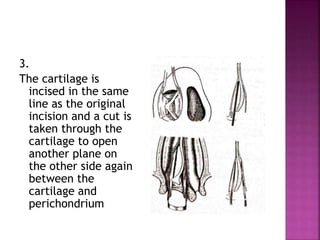 3.
The cartilage is
incised in the same
line as the original
incision and a cut is
taken through the
cartilage to open
another plane on
the other side again
between the
cartilage and
perichondrium
 
