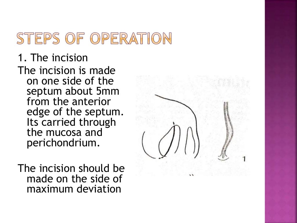 Smr and septoplasty