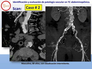 Screen Shot 2018-11-28 at 6.40.23 PM
Identificación y evaluación de patología vascular en TC abdominopélvica.
Scan:
Ma...