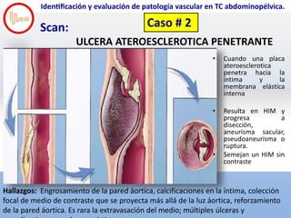 Screen Shot 2018-11-28 at 6.40.23 PM
Identificación y evaluación de patología vascular en TC abdominopélvica.
Scan:
UL...