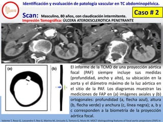 Screen Shot 2018-11-28 at 6.40.23 PM
Identificación y evaluación de patología vascular en TC abdominopélvica.
Scan: Ma...