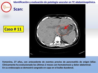 Screen Shot 2018-11-28 at 6.40.23 PM
Identificación y evaluación de patología vascular en TC abdominopélvica.
Scan:
Fe...