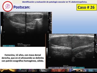 Postscan:
Identificación y evaluación de patología vascular en TC abdominopélvica.
Caso # 26
Femenina, 12 años, con ma...