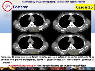 Postscan:
Identificación y evaluación de patología vascular en TC abdominopélvica.
Diagnostico histopatológico: Hemang...