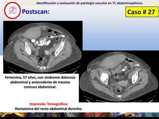 Postscan:
Identificación y evaluación de patología vascular en TC abdominopélvica.
Impresión Tomográfica:
Hematoma del...