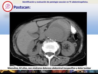 Masculino, 62 años, con síndrome doloroso abdominal inespecífico y dolor lumbar
Postscan:
Identificación y evaluación de...