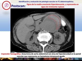 Postscan:
Identificación y evaluación de patología vascular en TC abdominopélvica.
Impresión Tomográfica: Aneurisma de...