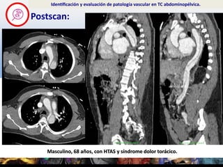 Postscan:
Identificación y evaluación de patología vascular en TC abdominopélvica.
Masculino, 68 años, con HTAS y sínd...