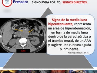 Prescan:
Radiology. 1999;211:37-38.
AAA
SIGNOLOGÍA POR TC: SIGNOS DIRECTOS.
 