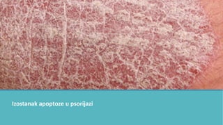 Izostanak apoptoze u psorijazi
 