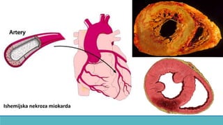 Ishemijska nekroza miokarda
 