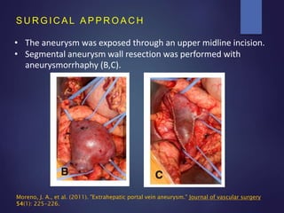 S U R G I C A L A P P R O A C H
• The aneurysm was exposed through an upper midline incision.
• Segmental aneurysm wall resection was performed with
aneurysmorrhaphy (B,C).
Moreno, J. A., et al. (2011). "Extrahepatic portal vein aneurysm." Journal of vascular surgery
54(1): 225-226.
 