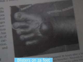 Blisters on za feet 
