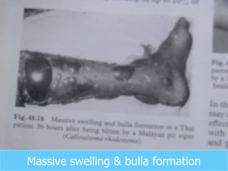 Massive swelling & bulla formation 