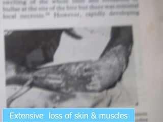 Extensive  loss of skin & muscles 