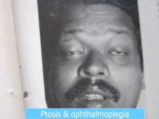 Ptosis & ophthalmoplegia 