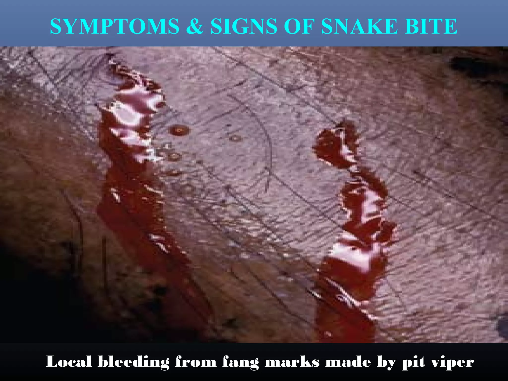 SYMPTOMS & SIGNS OF SNAKE BITE




Local bleeding from fang marks made by pit viper
 