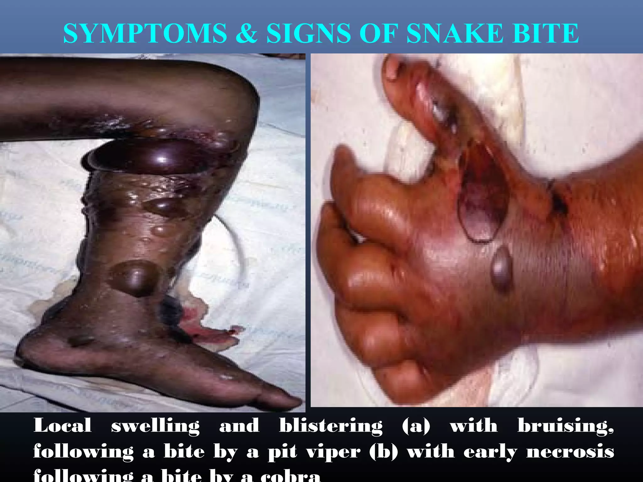 SYMPTOMS & SIGNS OF SNAKE BITE




Local swelling and blistering (a) with bruising,
following a bite by a pit viper (b) with early necrosis
 