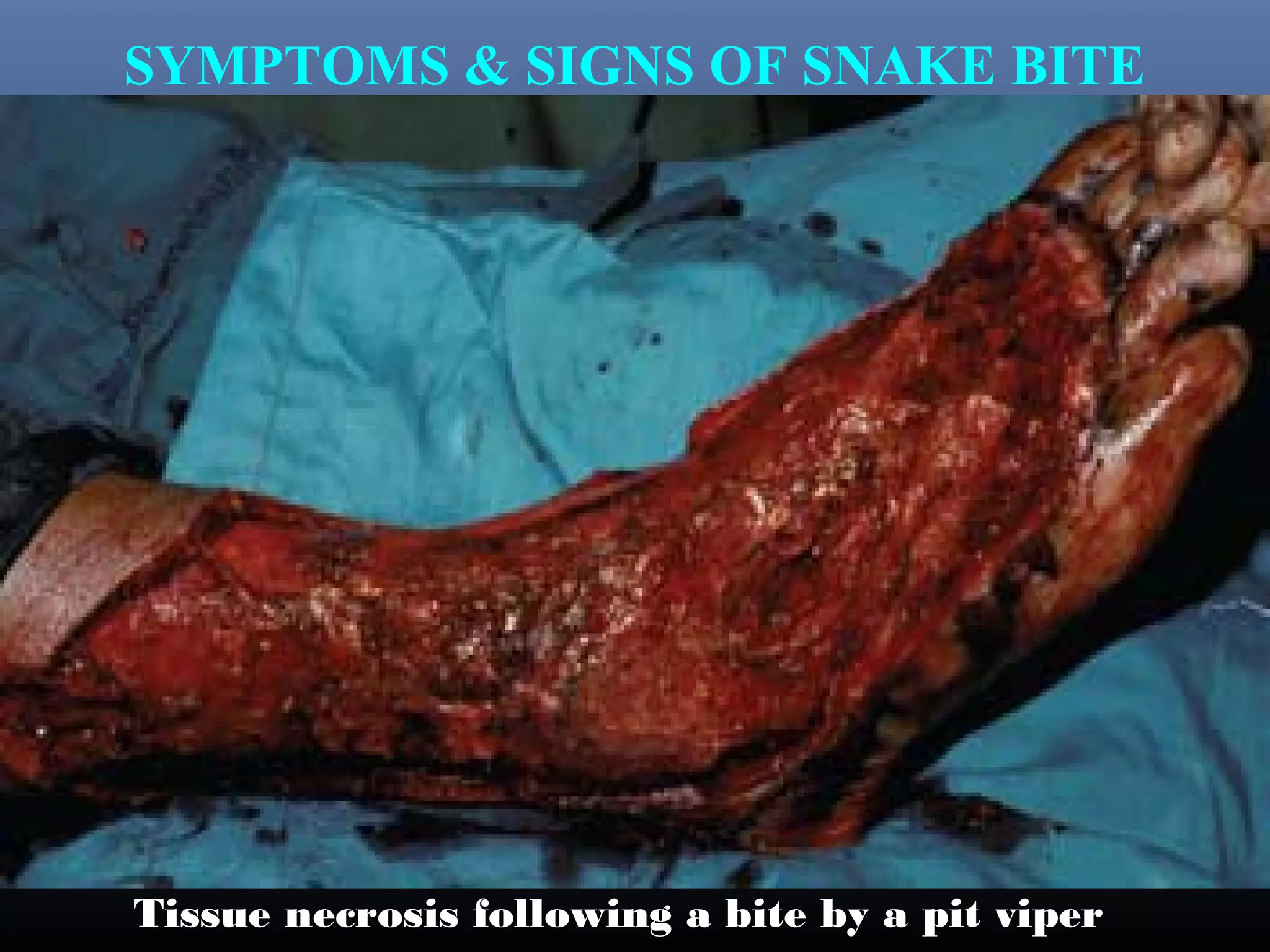 SYMPTOMS & SIGNS OF SNAKE BITE




Tissue necrosis following a bite by a pit viper
 