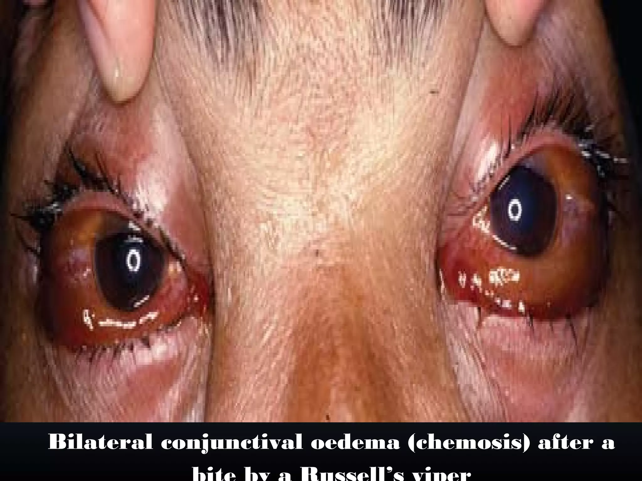 Bilateral conjunctival oedema (chemosis) after a
 
