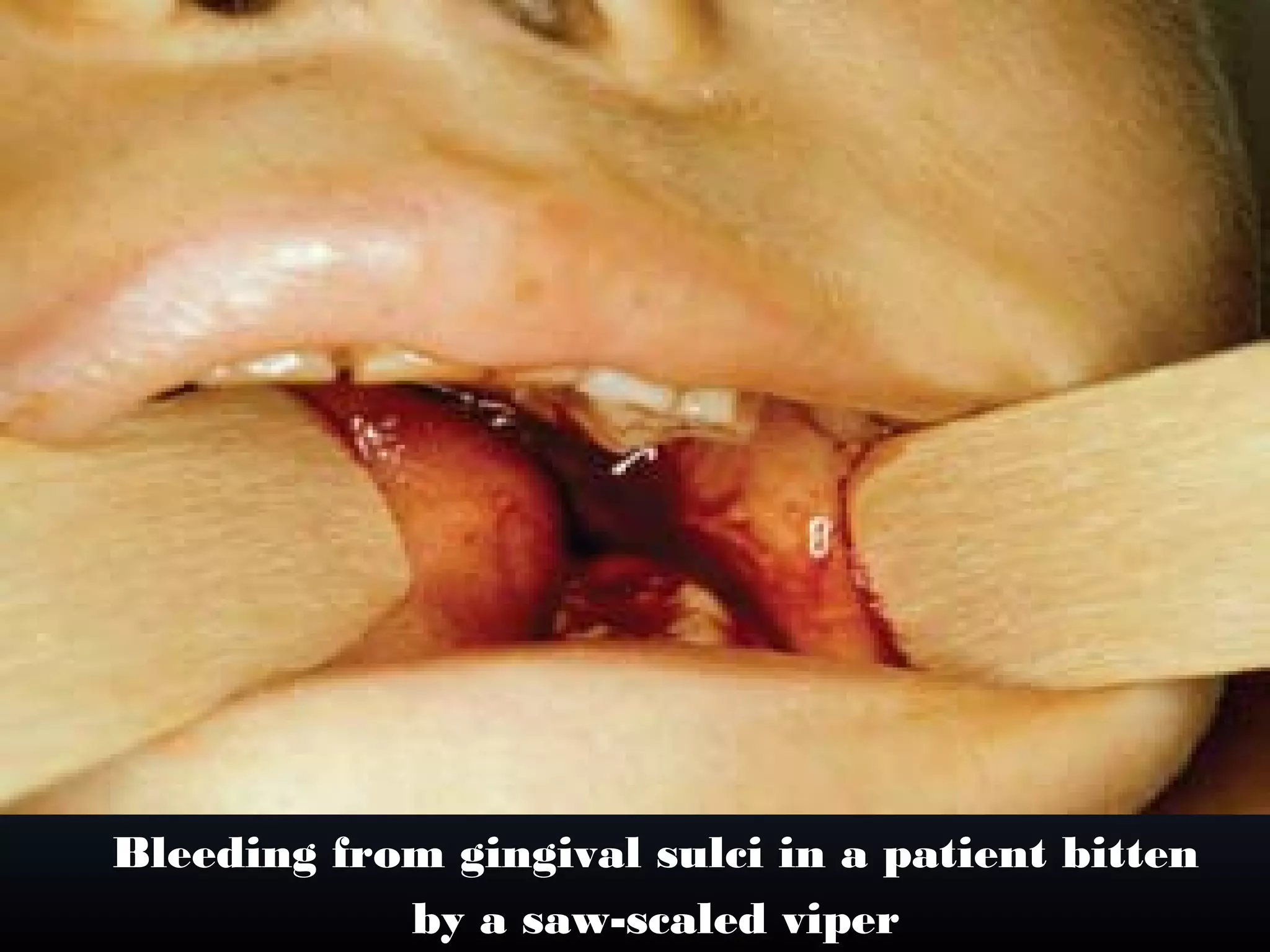 Bleeding from gingival sulci in a patient bitten
            by a saw-scaled viper
 