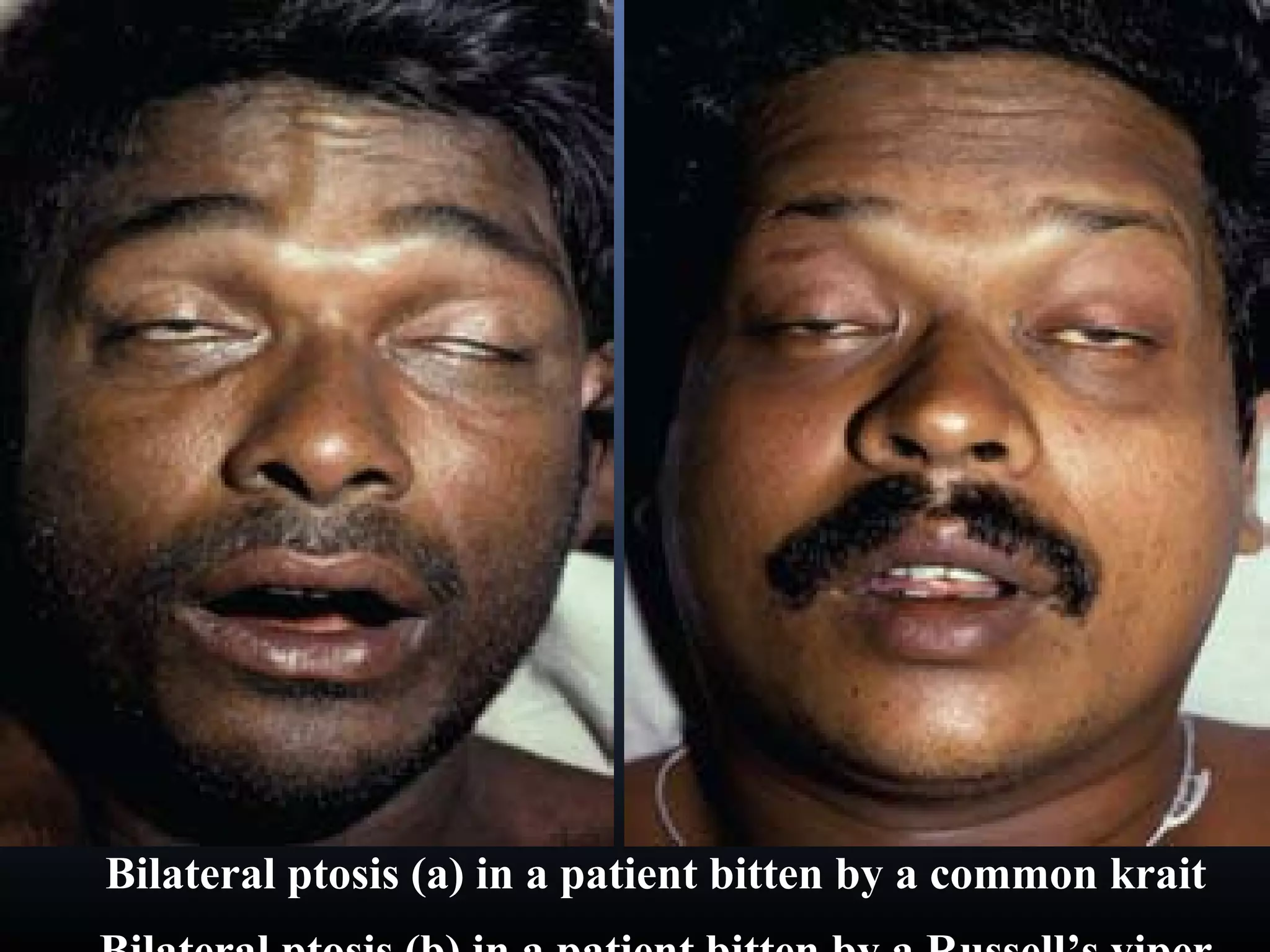 Bilateral ptosis (a) in a patient bitten by a common krait
 