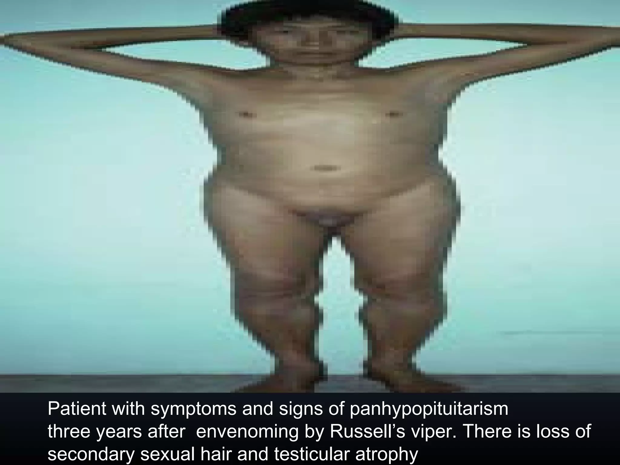Patient with symptoms and signs of panhypopituitarism
three years after envenoming by Russell’s viper. There is loss of
secondary sexual hair and testicular atrophy
 