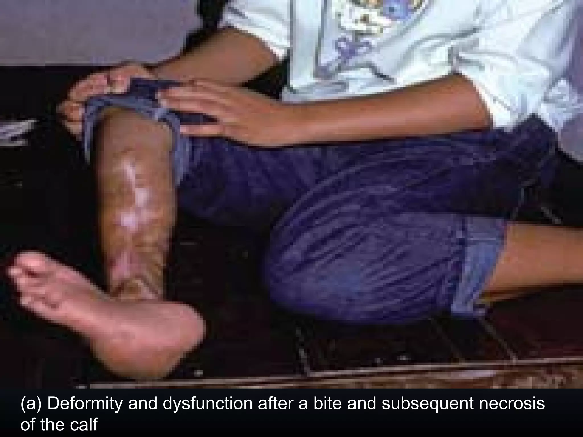 (a) Deformity and dysfunction after a bite and subsequent necrosis
of the calf
 