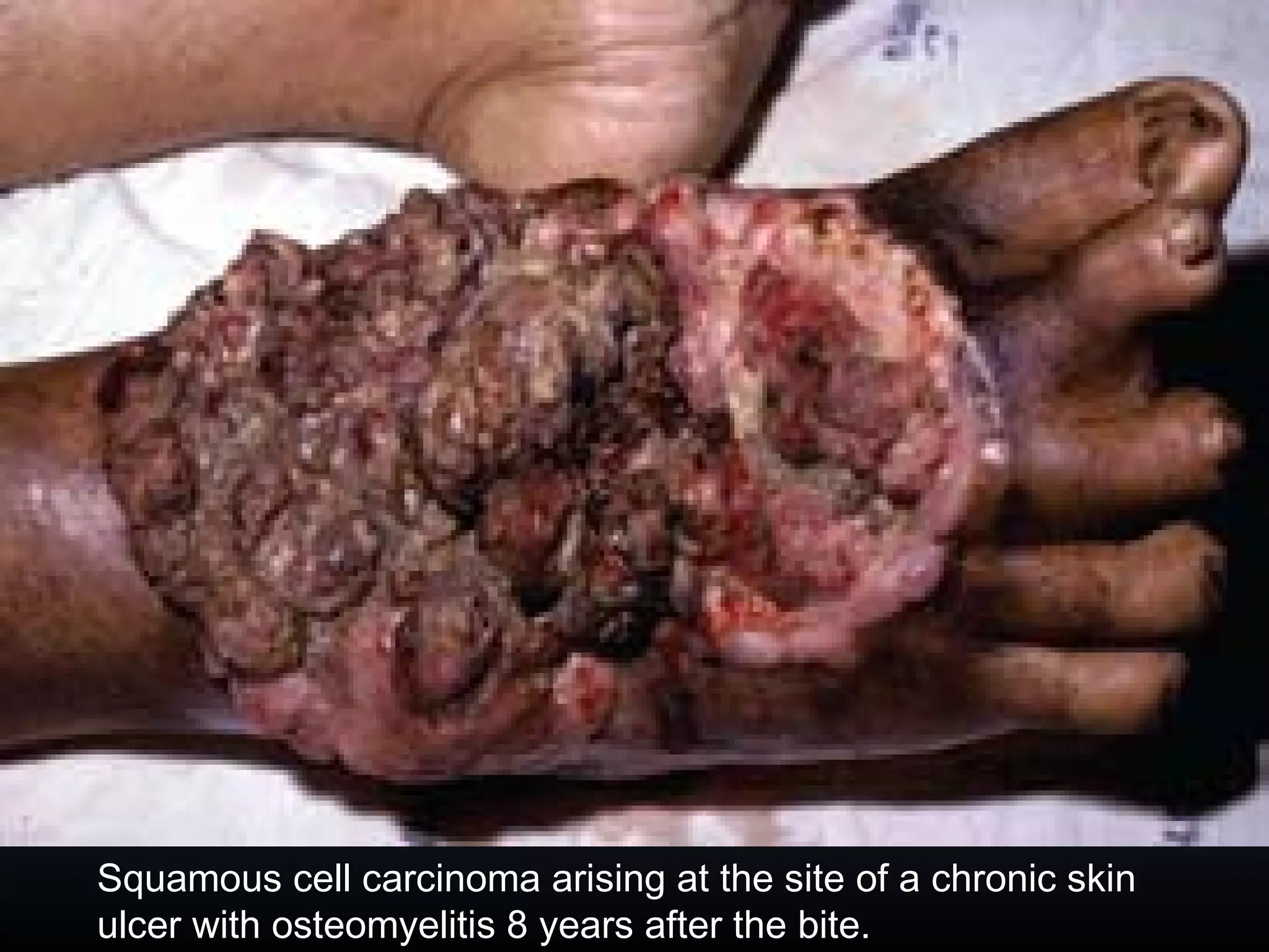 Squamous cell carcinoma arising at the site of a chronic skin
ulcer with osteomyelitis 8 years after the bite.
 