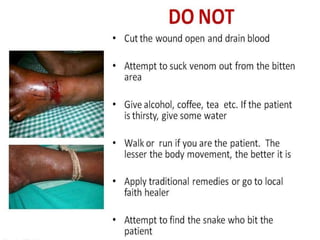 Snake bite First Aid