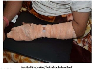 Snake bite First Aid