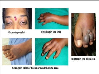 Snake bite First Aid