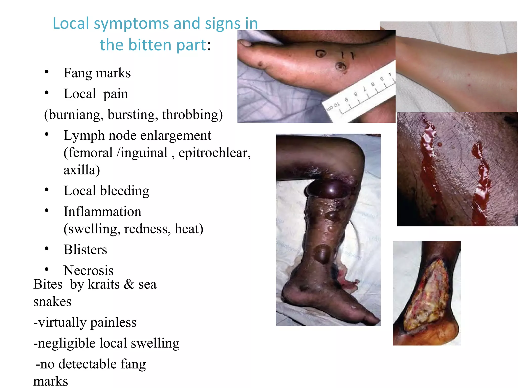 Local symptoms and signs in
the bitten part:
• Fang marks
• Local pain
(burniang, bursting, throbbing)
• Lymph node enlargement
(femoral /inguinal , epitrochlear,
axilla)
• Local bleeding
• Inflammation
(swelling, redness, heat)
• Blisters
• Necrosis
Bites by kraits & sea
snakes
-virtually painless
-negligible local swelling
-no detectable fang
marks
 