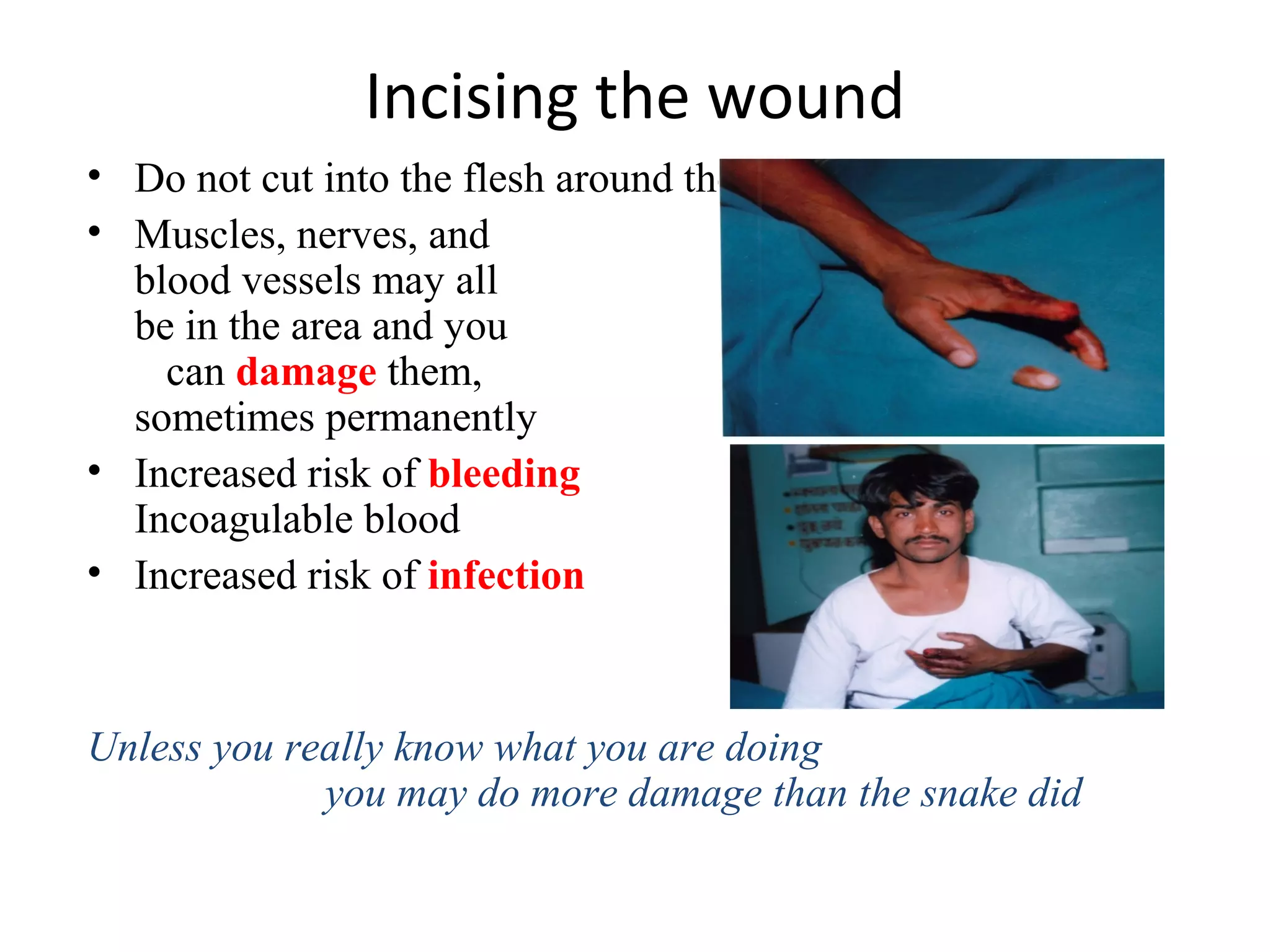 Incising the wound
• Do not cut into the flesh around the fang marks.
• Muscles, nerves, and
blood vessels may all
be in the area and you
can damage them,
sometimes permanently
• Increased risk of bleeding –
Incoagulable blood
• Increased risk of infection
Unless you really know what you are doing
you may do more damage than the snake did
 