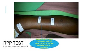 Lowest side of tape
1to lowest side of
tape 2 is 4 cm. So we
have RPP test is 2
cm/hour
RPP TEST
RATE PROXIMAL PROGRESSION TEST
 