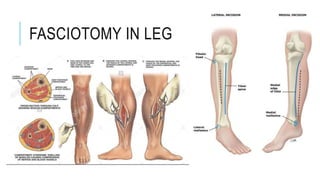 FASCIOTOMY IN LEG
 