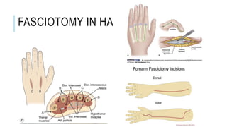 FASCIOTOMY IN HAND
 